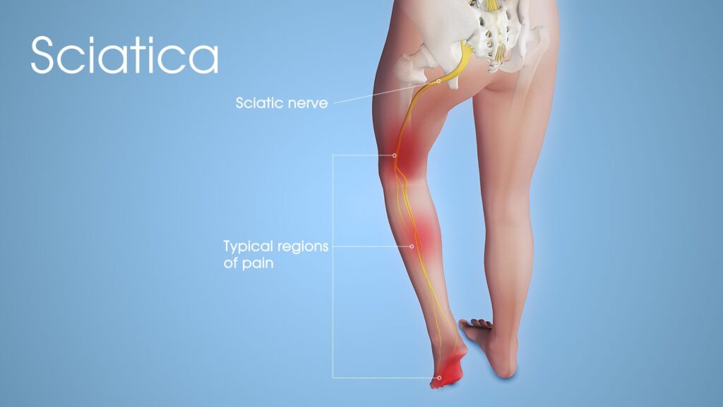 Sciatic Pain Helped by a Oceanside Chiropractor
