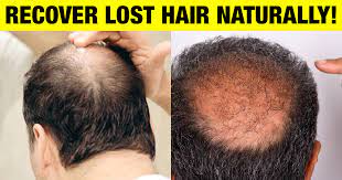 How to Get Back Lost Hair?